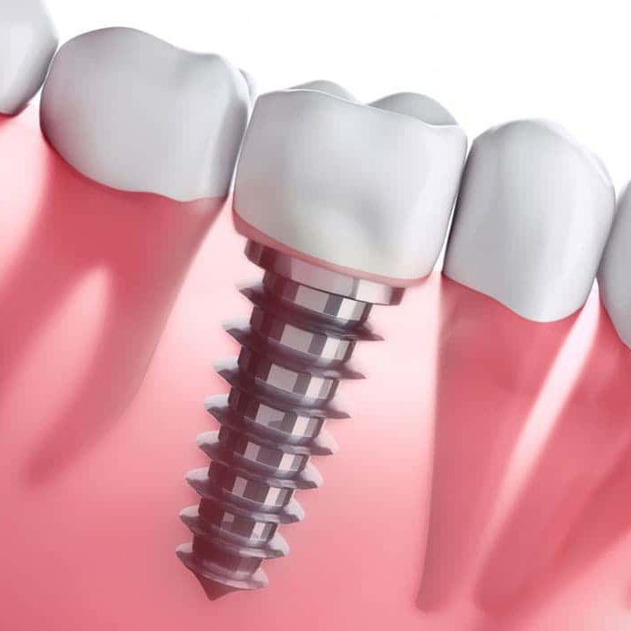 hình ảnh dịch vụ trồng răng implant