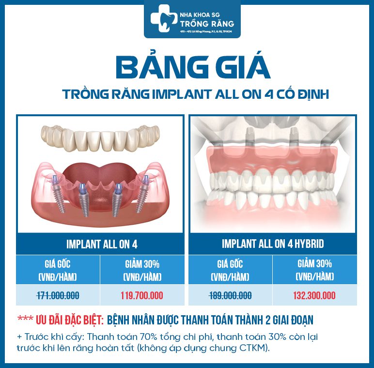 Bảng giá trồng răng Implant all on 4 toàn hàm Bảng giá trồng răng Implant all on 4 toàn hàm