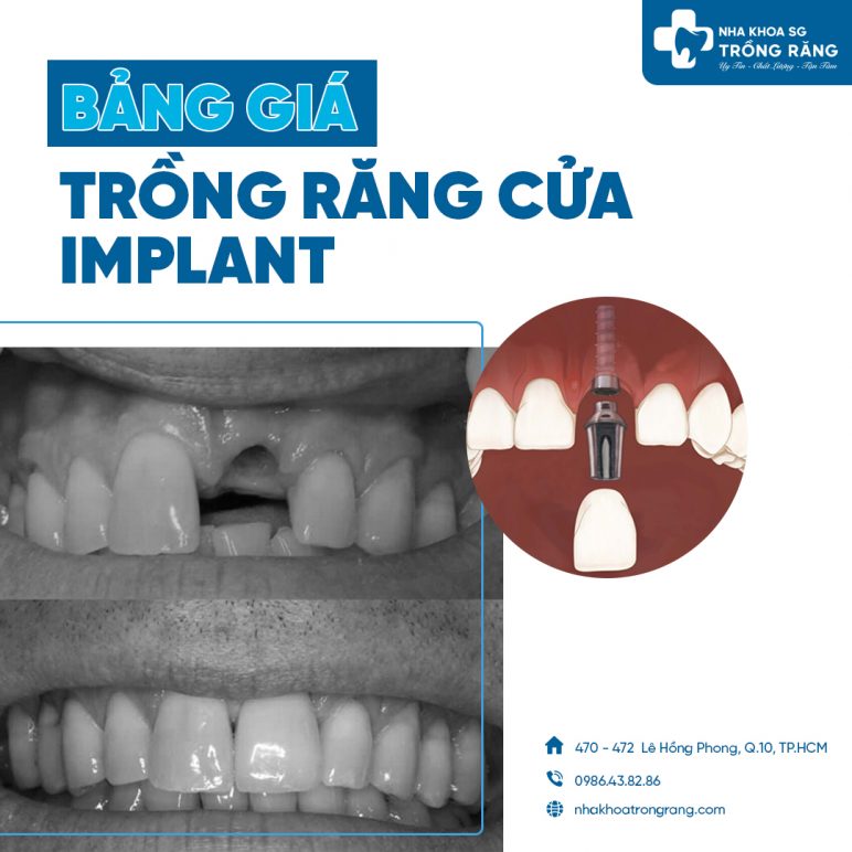 Bảng giá trồng răng cửa Implant