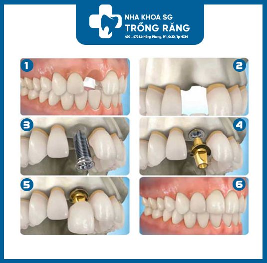 Bước 3 – Lập kế hoạch điều trị và tư vấn trồng răng implant