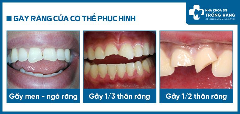 6 Cách Trồng Răng Cửa Bị Gãy Bạn Nên Biết - Nha Khoa Sài Gòn ®