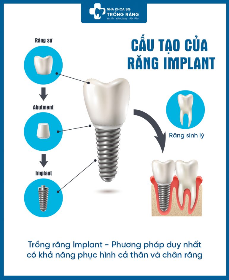Cấu tạo trồng răng Implant