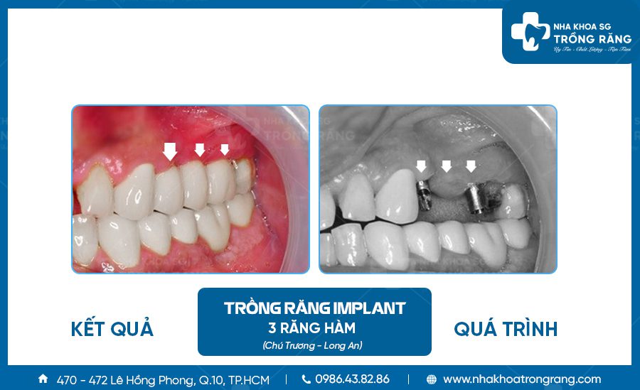 Chú Trương trồng 3 răng hàm implant