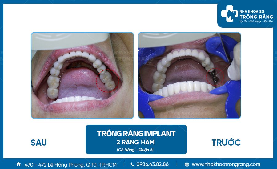 Cô Hồng - Quận 5 trồng implant 2 răng hàm