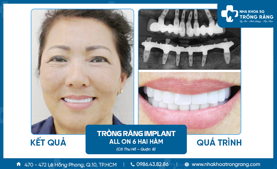 Cô Thu Hồ trồng răng implant all on 6 hai hàm