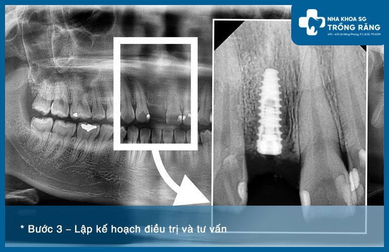 Film trồng răng cửa Implant