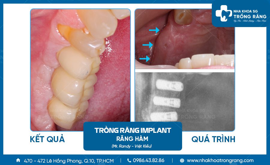 Hình ảnh trồng implant 3 răng nhai hàm trên