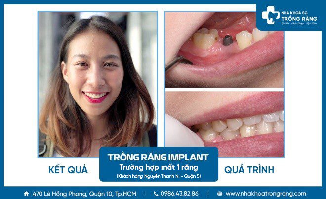 Kết quả trồng răng implant mất 1 răng nhai