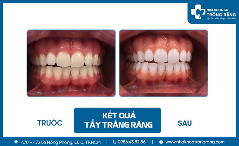 Lam trang rang tai nha khoa Làm trắng răng tại nha khoa