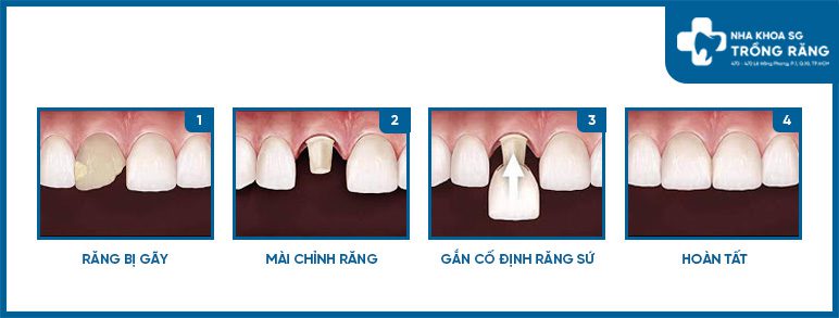 Mo phong Boc su rang cua bi gay Mô phỏng Bọc sứ răng cửa bị gãy