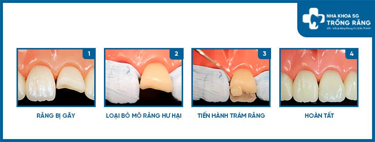 Mo phong Tram rang cua bi gay Mô phỏng Trám răng cửa bị gãy