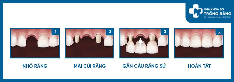 Mo phong trong rang bac cau rang cua bi gay Mô phỏng trồng răng bắc cầu răng cửa bị gãy