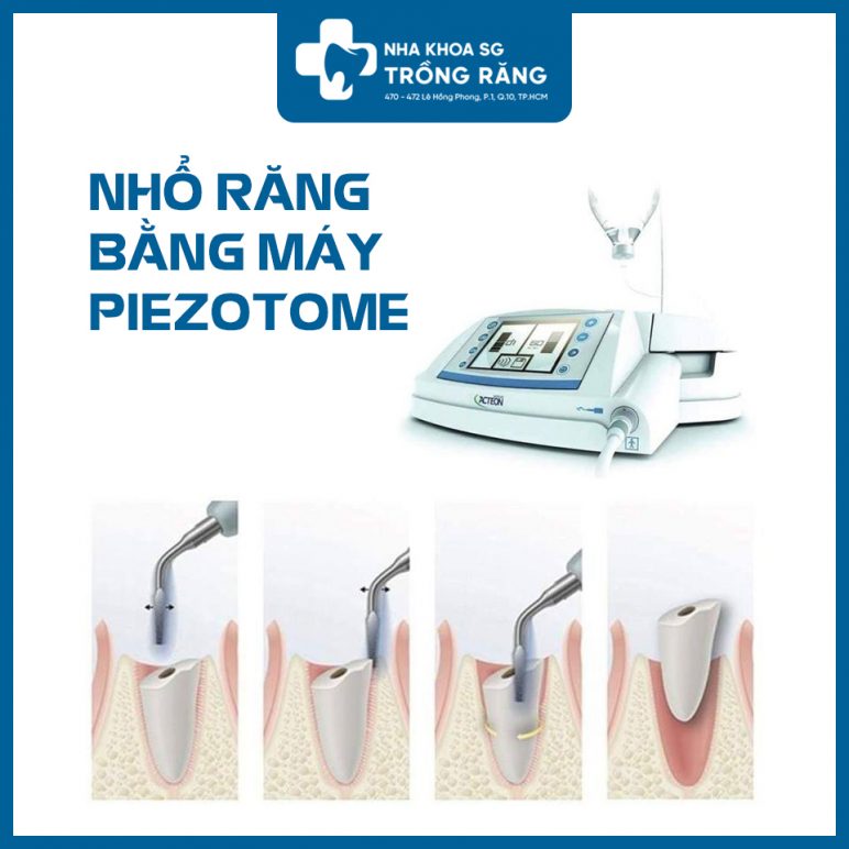 Quy trình nhổ răng bằng máy siêu âm Piezotome