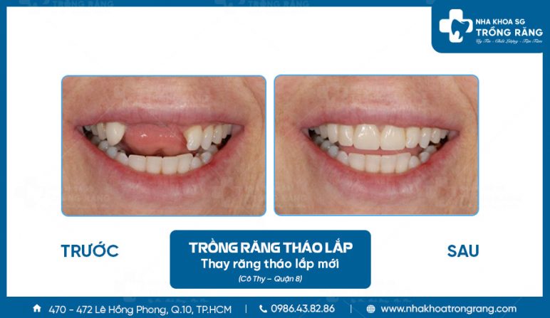 Rang thao lap co Thy e1627268119995 Răng tháo lắp cô Thy