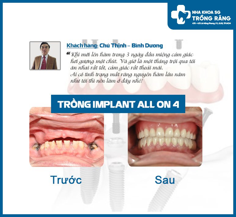 Chú Thịnh Review trồng implant all on 4