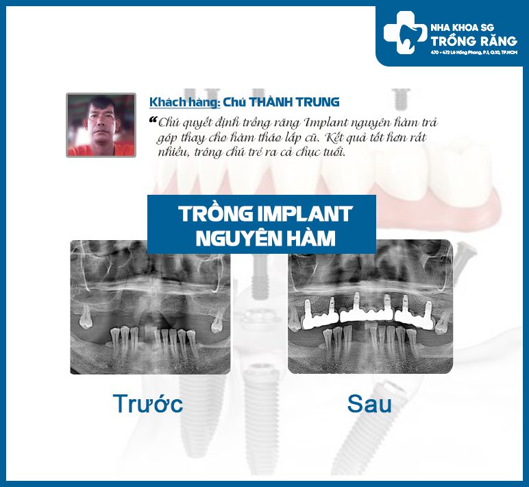 Review trồng răng implant nguyên hàm 6 trụ Review trồng răng implant nguyên hàm 6 trụ