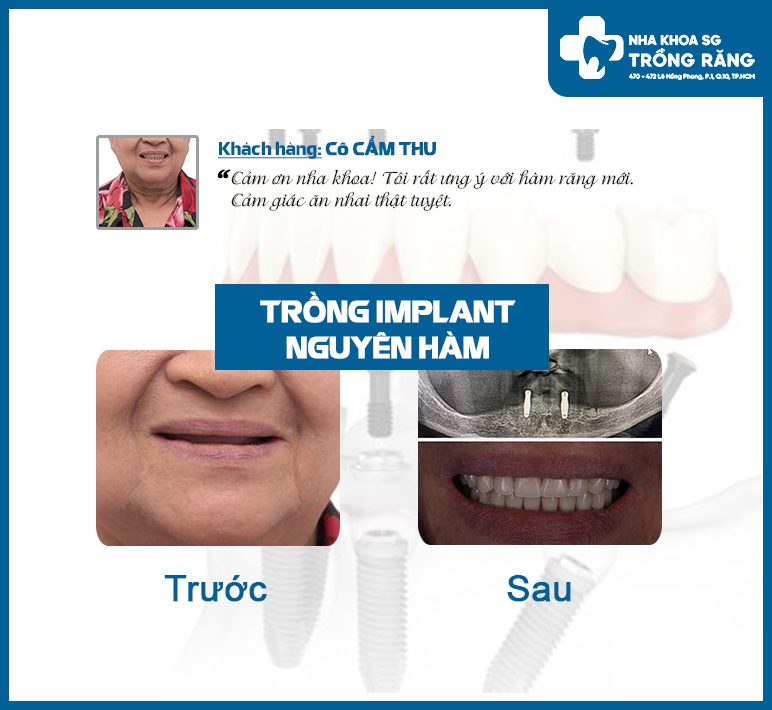 Review trồng răng implant nguyên hàm all on 2