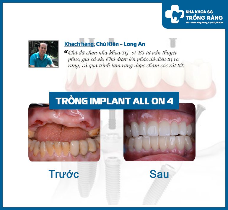 Review trồng răng implant nguyên hàm all on 4