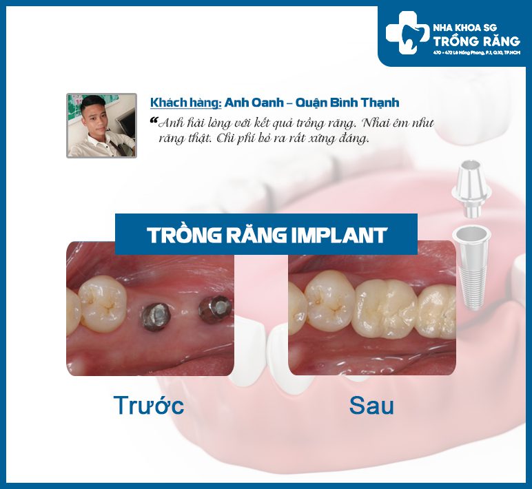 Trồng implant khi mất răng hàm 2 cái