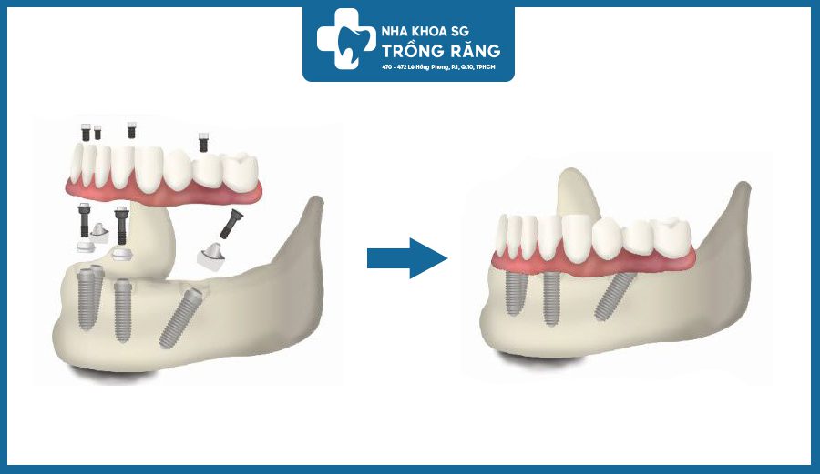 Trong rang Implant all on 4 toan ham co dinh Trồng răng Implant all on 4 toàn hàm cố định