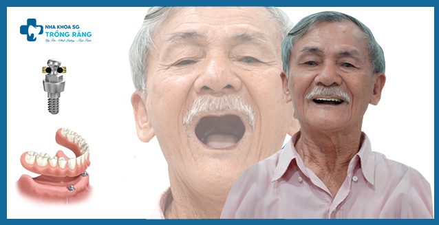 Trồng răng implant all on 2 cho người lớn tuổi