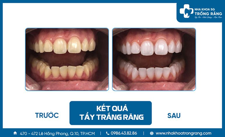 Trước và sau khi tẩy trắng răng tại phòng khám