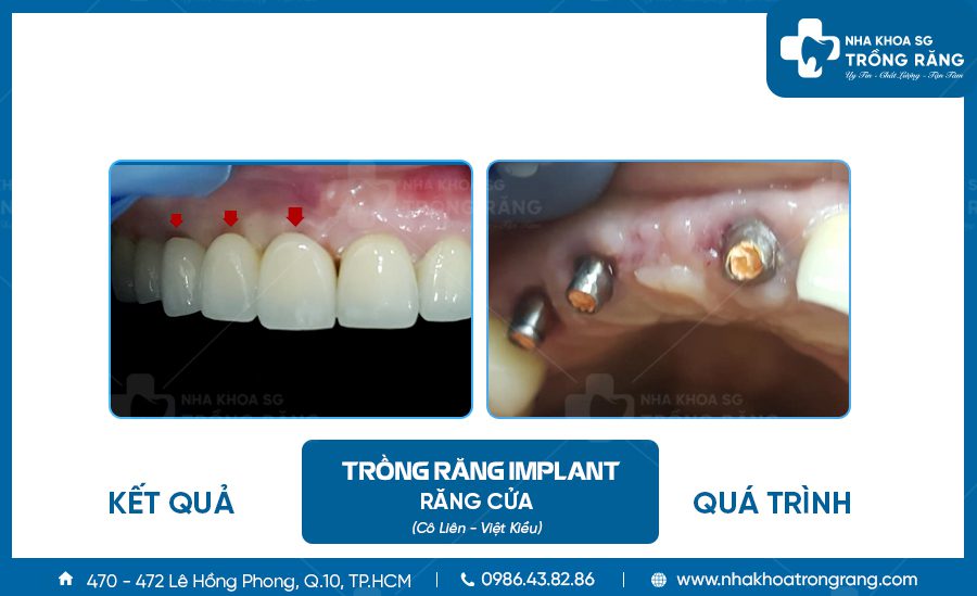 Việt kiều trồng răng cửa implant 3 trụ