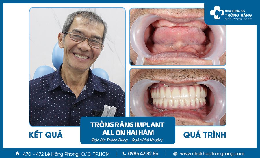 Chú Dũng trồng răng Implant All on 4 hai hàm
