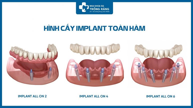 mô phỏng trồng răng implant toàn hàm