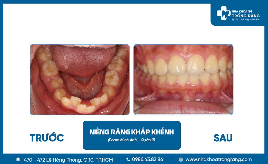 nieng rang khap khenh 1 nieng rang khap khenh 1