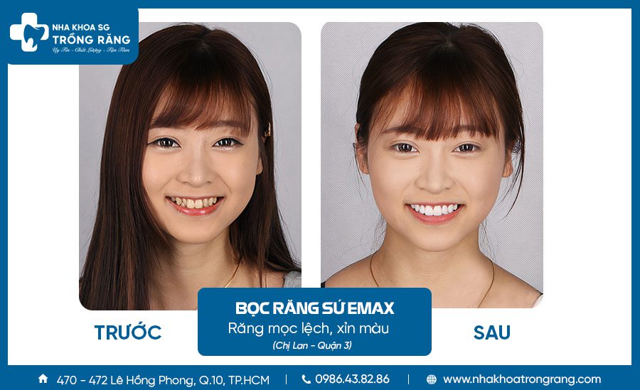 Bọc răng sứ bị sưng nướu phải làm sao?