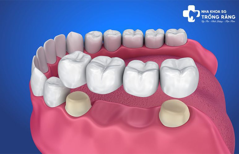 Bắt cầu răng sứ 4 răng Bắt cầu răng sứ 4 răng