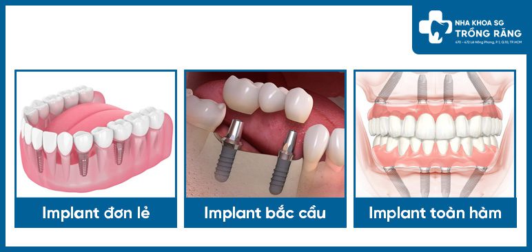 Các dạng trồng răng implant