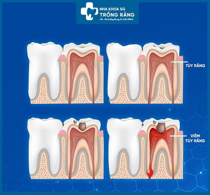 Các dạng viêm tủy răng