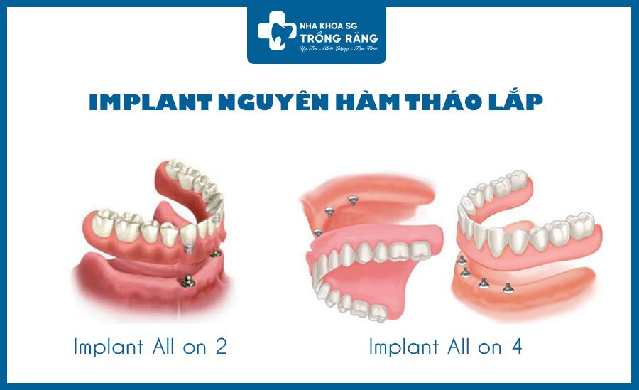 Các loại trồng răng implant tháo lắp
