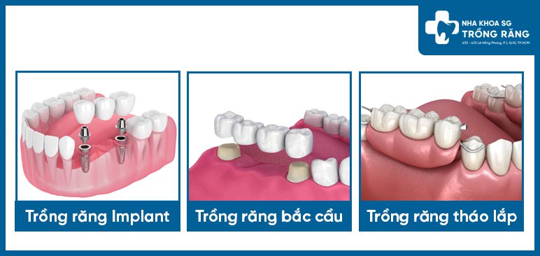 Các phương pháp trồng 3 răng