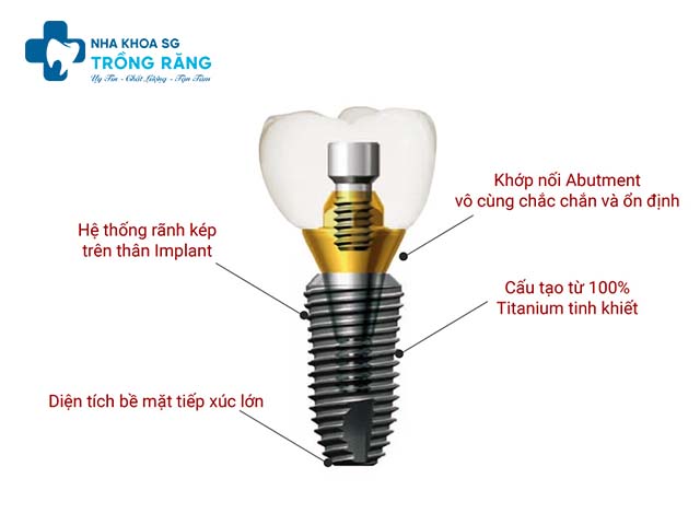 Cau tao mot chiec rang implant Cấu tạo một chiếc răng implant