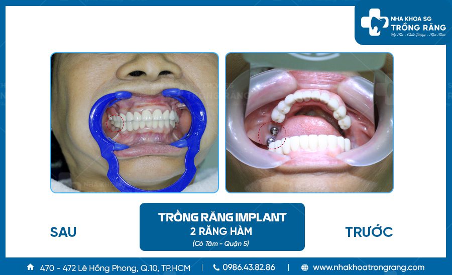 Cô Tâm - Quận 5 trồng 2 răng implant hàn quốc
