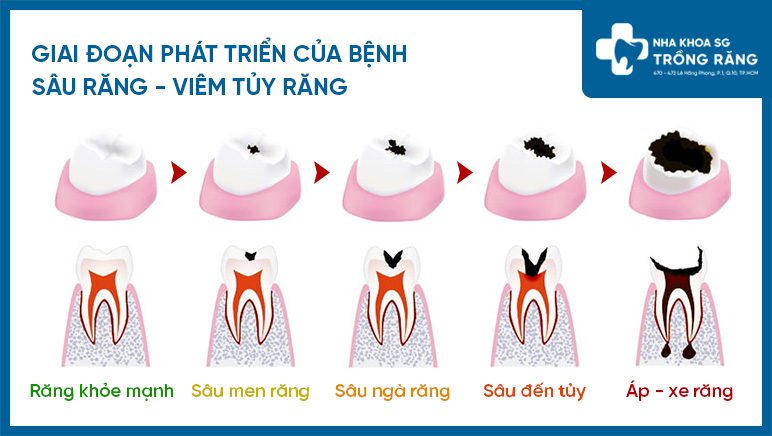 Giai đoạn phát triển của bệnh sâu răng viêm tủy răng Giai đoạn phát triển của bệnh sâu răng viêm tủy răng