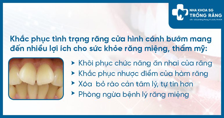 Lí do nên khắc phục tình trạng răng cửa hình cánh bướm Lí do nên khắc phục tình trạng răng cửa hình cánh bướm