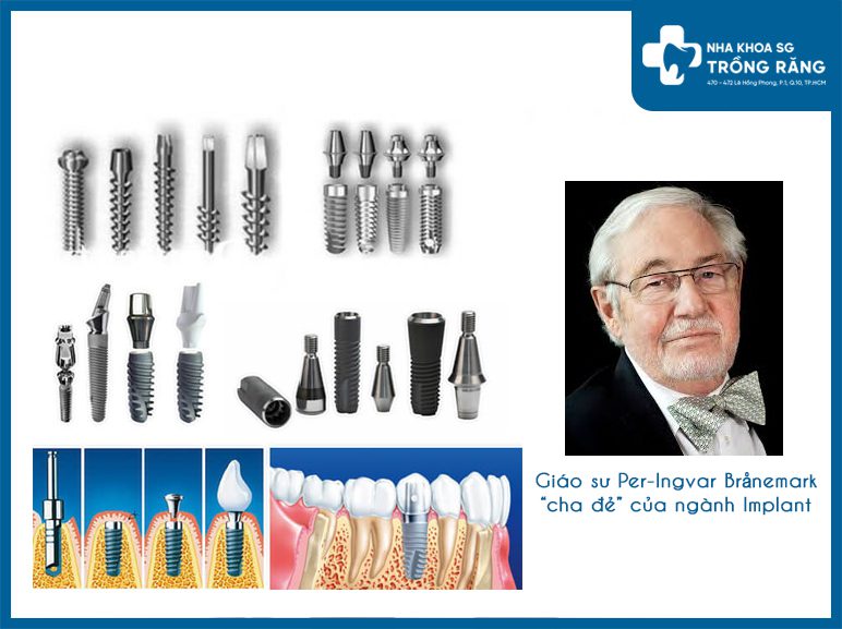 Lich su cua trong rang implant Lịch sử của trồng răng implant