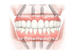 Mô Hình Trồng răng Implant All On 4