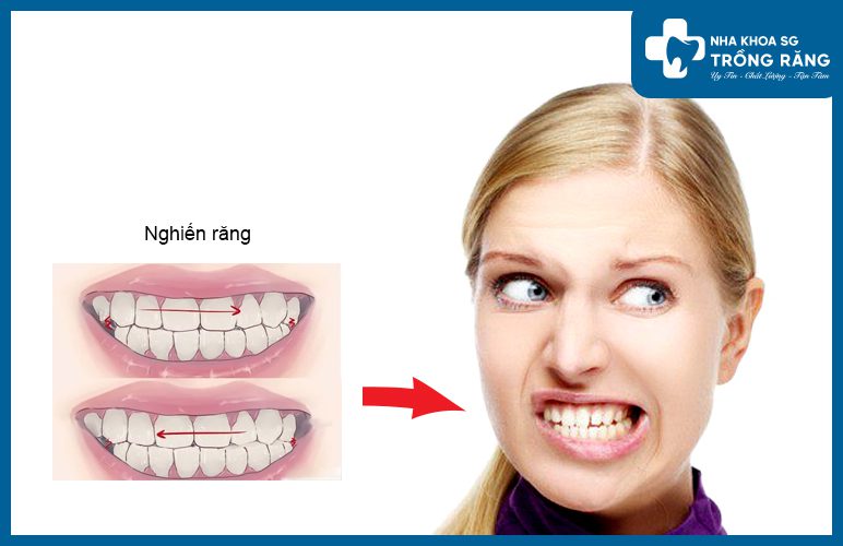 Nghiến răng có nguy cơ làm đau nhức răng
