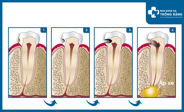 Sự phát triển của sâu răng