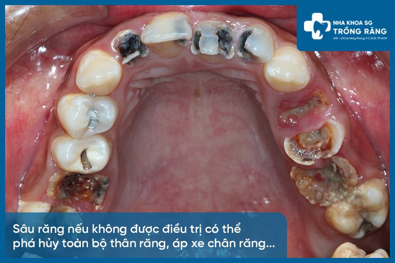 Tác hại sâu răng Tác hại sâu răng