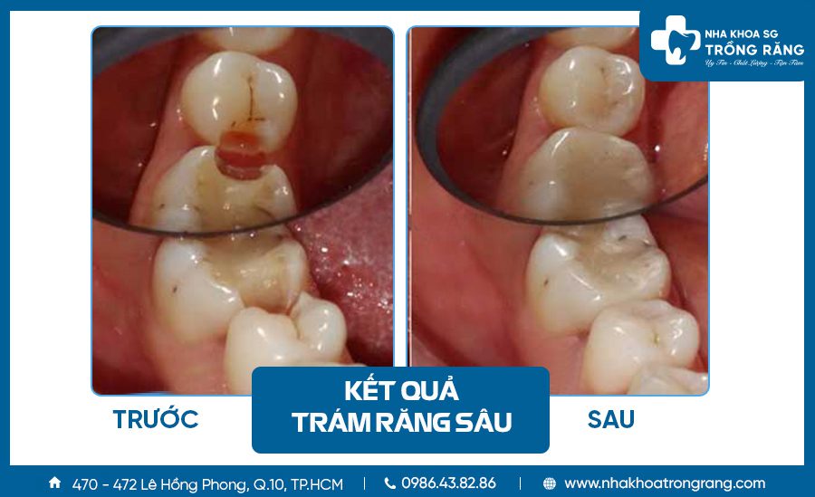 Trám răng sâu lỗ to Trám răng sâu lỗ to