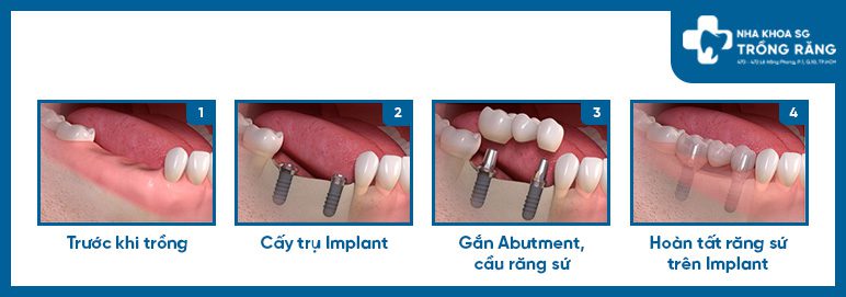 Trồng răng Implant 3 răng