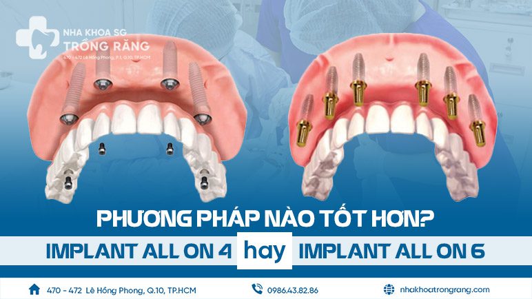 Trồng răng Implant All On 6 và Implant All On 4