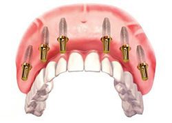 Trồng răng Implant All On 6