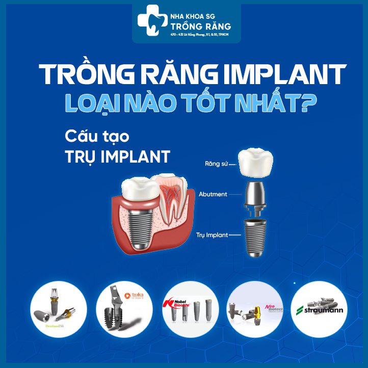 Trong rang Implant loai nao tot nhat Trồng răng Implant loại nào tốt nhất